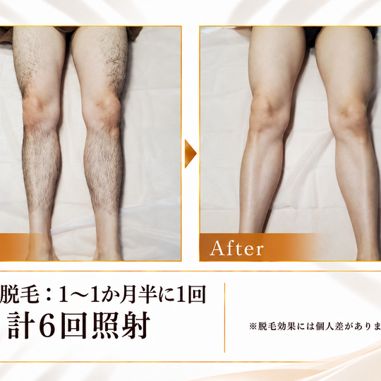 両脚脱毛のビフォーアフター-6
