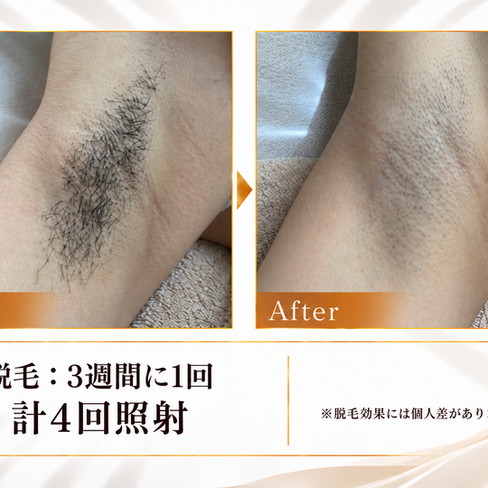 脇脱毛のビフォーアフター-10