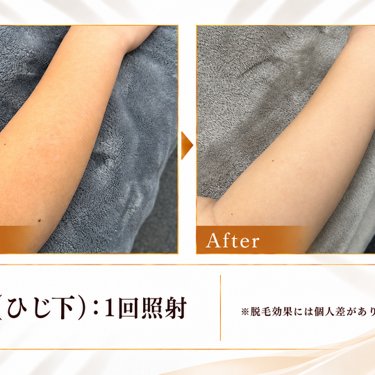 腕（ひじ下）脱毛のビフォーアフター-9