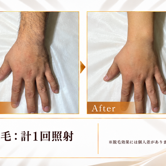 腕の脱毛ビフォーアフター-4